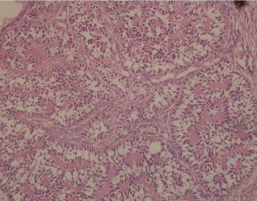 Granulosa cell tumour showing neoplastic cells arranged in tubular pattern. H & E x 200