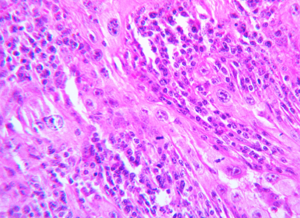 ocular squamous cell carcinoma