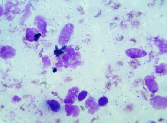 Cytology of this ocular tumor showing spindle shape cells with plumpy prominent nucleus and prominent nucleoli in few of nucleus (Leishman Stain; 1000X).