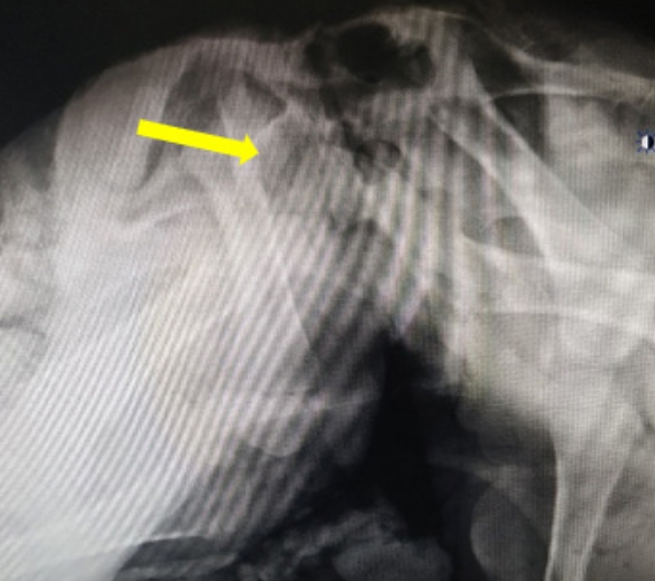 Radiograhpic image of ischiopagus monster.