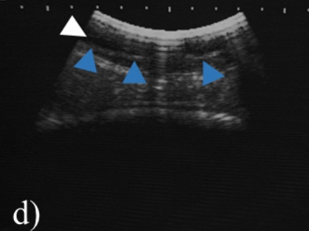 ultrasonographic image of the surgical site showing the mesh line (blue arrowheads) and seroma beneath the mesh (white arrow).